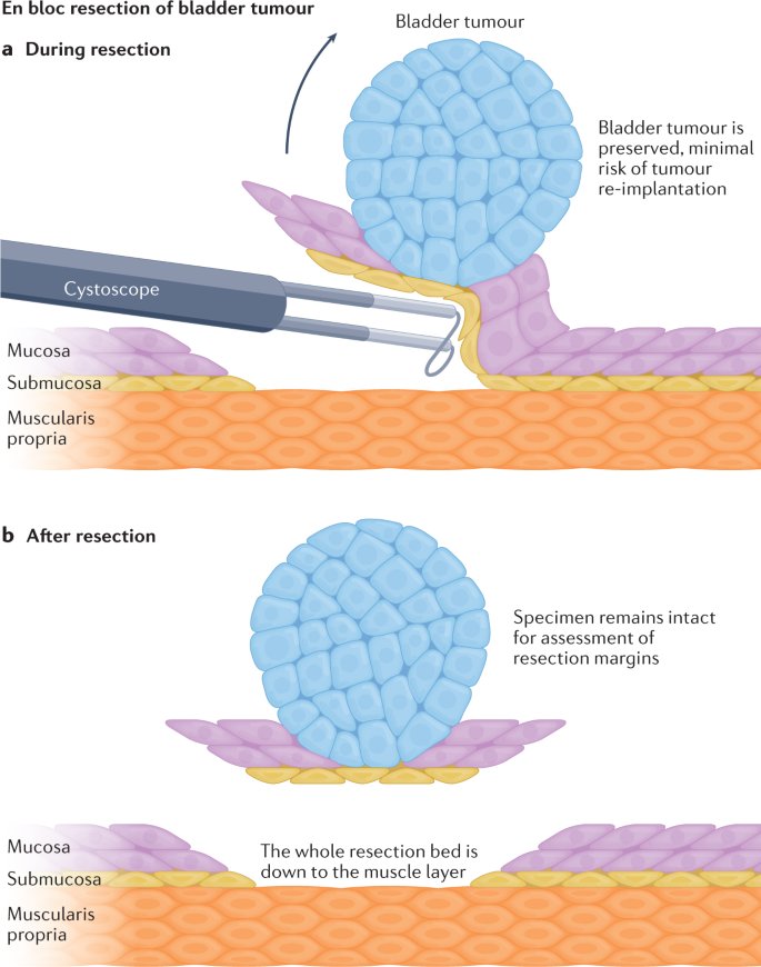 En bloc tumor resection (ERBT) has been proposed as an alternative technique, allowing for the complete removal of the tumor and surrounding tissue (Figure 1).