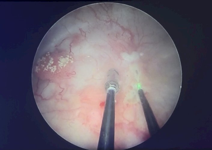 Intraoperative screen capture of video demonstration for the Virtuoso Surgical Endoscopic System. A). Identification of bladder tumor. B). Surgical resection of bladder tumor via En Bloc technique.
