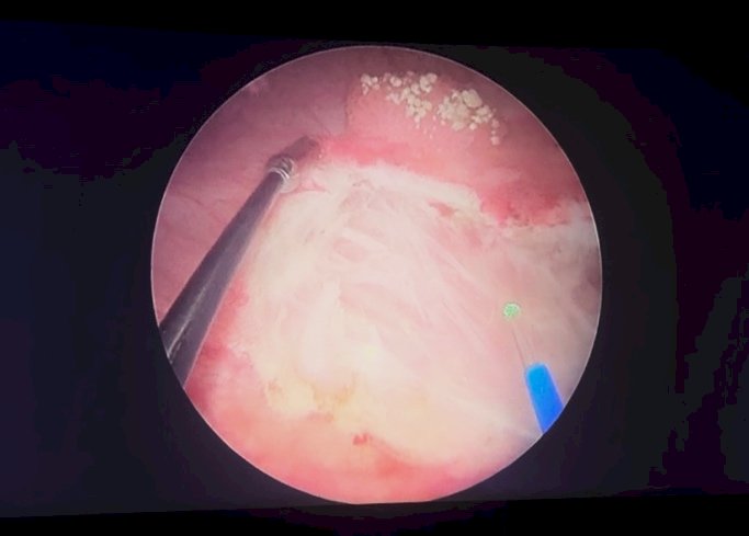 Intraoperative screen capture of video demonstration for the Virtuoso Surgical Endoscopic System. A). Identification of bladder tumor. B). Surgical resection of bladder tumor via En Bloc technique. 3