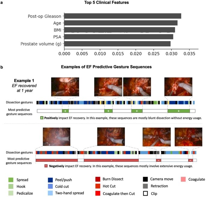 Figures from Dr. Hung’s lab show how various dissection gestures differed between patients who did and did not recover erectile function at 12 months. Quoting directly from his group’s published work: “To understand how these models make predictions, we ... ranked the important clinical features for 1-year EF prediction, which were Gleason score, age, BMI, PSA, and prostate volume. We also outputted important gesture sequences positively or negatively associated with 1-year EF recovery.”