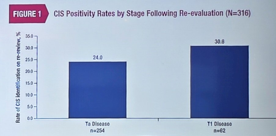 The rate of CIS found on pathology re-review ranged from 15.9% to 66.7% among the 8 pathologists who conducted initial reviews. The difference in the rate of CIS positivity between pathologists was statistically significant (p < 0.05). Overall, there were 80 cases (25.3%) of CIS identified on re-review, which were numerically higher in T1 disease (19/62, 30.6%) than in Ta disease (61/254, 24.0%):&nbsp;