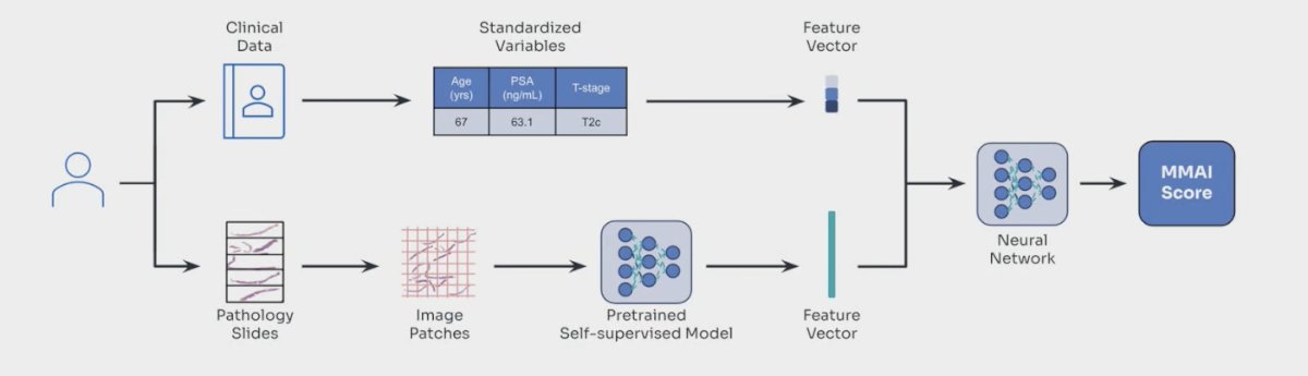 MMAI is a CLIA/CAP-certified, digital pathology–based multimodal artificial intelligence (AI) prognostic biomarker, developed and validated in localized prostate cancer treated with definitive radiation. The MMAI score is derived from H&E slide image features integrated with clinical data such as PSA, T stage, and age. Pathology slides are broken into image patches that are processed through a pretrained, self-supervised machine learning model to generate feature vectors, which are then combined with clinical variables in a neural network to output the MMAI score. Developed about 18 months ago, MMAI has since gained traction as a novel biomarker platform.