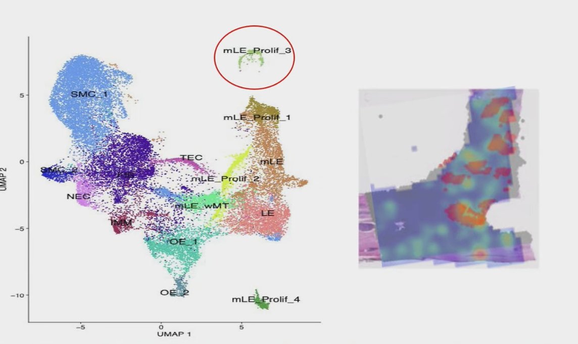 Lastly, building on the earlier DNA findings, Dr. Sutera showed that AI attention maps also revealed overexpression of MYC targets, nicely complementing the copy number gain data previously presented. This consistency between DNA alterations and transcriptional output supports the biological rationale for MMAI, reinforcing that the model is capturing relevant oncogenic pathways rather than noise.
