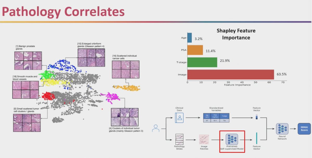 To peek inside the “image” black box, the team clustered slide patches from the self-supervised model and mapped them with UMAP. Several clusters aligned with recognizable histology—benign glands, smooth muscle/vessels, small, scattered tumor glands, and cribriform/Gleason pattern 4—while a large gray region reflected image features pathologists can’t yet label, hinting at novel or composite signals. Shapley analysis showed the MMAI score is driven predominantly by image features (~64%), with smaller contributions from T stage (~22%), PSA (~11%), and age (~3%). Net: MMAI’s prognostic power comes mainly from morphology the network extracts; some of it matches what we already recognize, and some of it may represent underappreciated biology worth interrogating.