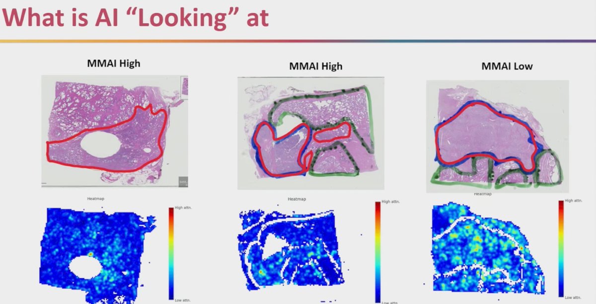 Dr. Sutera emphasized that the AI-driven MMAI model is not pinpointing isolated foci of aggressive disease but is instead focusing on the tumor as a whole. As illustrated in the heat maps, areas of highest attention are concentrated within the malignant tissue, while benign glands and stromal components are largely ignored. This suggests that the AI is capturing biologically relevant features of the tumor itself, rather than being misled by surrounding non-malignant structures.&nbsp;