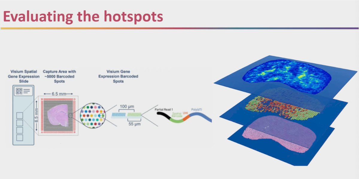 Dr. Sutera went on to describe efforts using spatial transcriptomics to overlay H&E pathology with gene expression data. This approach helps evaluate “hotspots” of AI attention and interrogates what biological features may be driving the MMAI signal. By combining U-map clustering with transcriptomic overlays, investigators can begin to understand not just where AI is focusing within tumors, but also what genomic programs might underlie these regions of interest. This adds a biologic rationale to the MMAI score and moves closer toward deciphering the black box of AI-driven pathology.