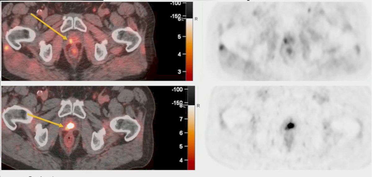This figure highlights another advantage of 18F-fluciclovine (Axumin) PET/CT compared with PSMA PET/CT. Because Axumin is not excreted through the urine, it avoids the confounding effect of bladder activity, which can obscure local recurrence in the prostate bed. As shown in the case example, recurrent disease is clearly visible on Axumin PET/CT, whereas PSMA PET/CT, obscured by urinary tracer excretion, fails to detect the lesion.