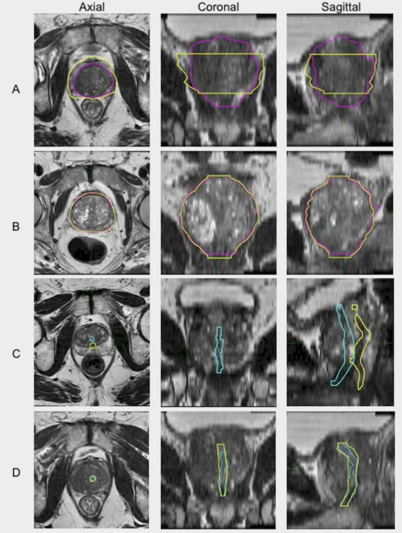 Physicians&nbsp;who&nbsp;diagnose&nbsp;or treat&nbsp;prostate cancer&nbsp;were invited to&nbsp;contour&nbsp;the&nbsp;prostate and urethra&nbsp;on&nbsp;up to&nbsp;4&nbsp;patient cases using standard&nbsp;T2-weighted&nbsp;MRI&nbsp;(all planes).&nbsp;These contours were compared to&nbsp;reference&nbsp;consensus segmentations produced by a multidisciplinary panel of experts. Performance of a validated prostate auto-segmentation&nbsp;AI&nbsp;tool was also&nbsp;evaluated.&nbsp;The investigators assessed contour accuracy with Dice&nbsp;similarity&nbsp;coefficient,&nbsp;deviation from&nbsp;boundary (mm),&nbsp;absolute volume&nbsp;difference&nbsp;(%),&nbsp;and overlap&nbsp;(%):&nbsp;