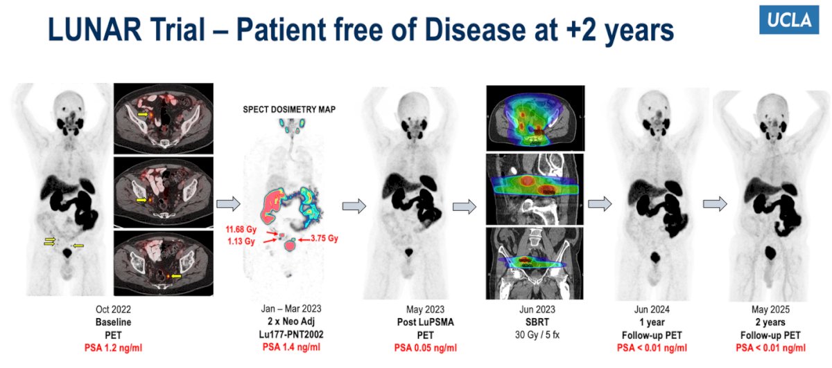 Dr. Calais presented a representative case from the LUNAR trial showing a patient with oligometastatic recurrence who achieved complete disease remission two years after treatment. The patient received two cycles of neoadjuvant 177Lu-PNT2002 followed by SBRT (30 Gy in 5 fractions), resulting in a progressive PSA decline from 1.2 ng/mL at baseline to <0.01 ng/mL at 24 months, with sustained disease-free status on serial PSMA PET/CT imaging.