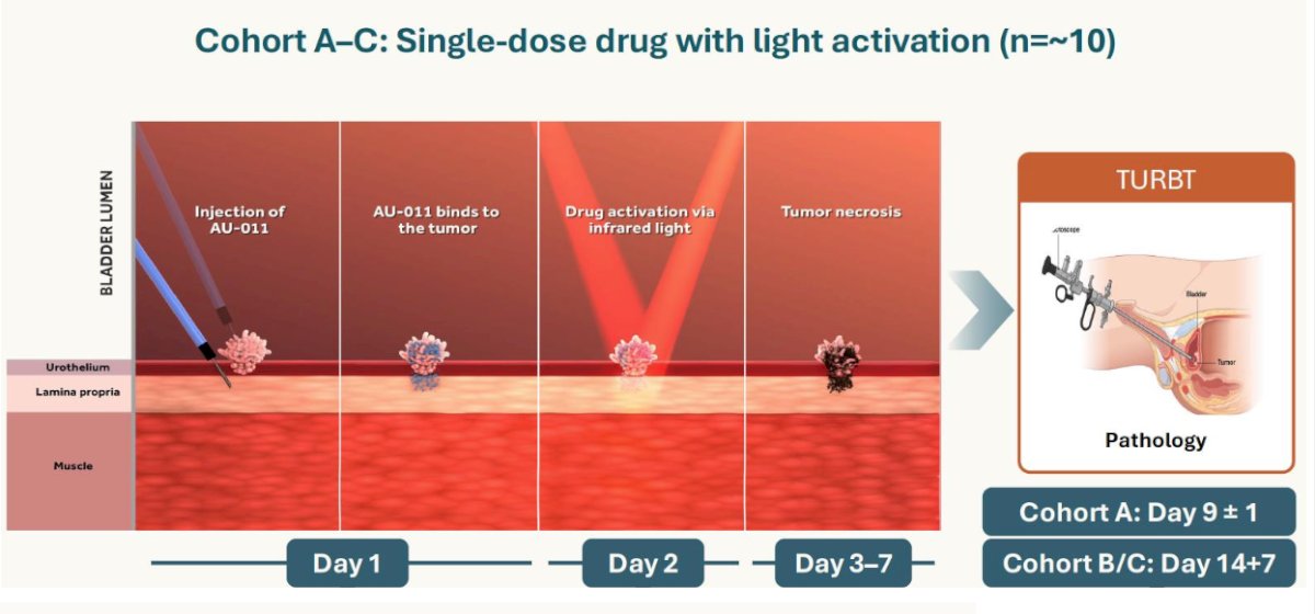 &nbsp;Finally, Dr. Agarwal discussed AU-011, which uses viral-like particles conjugated to a photosensitizer and is activated by near infrared light. Cells are disrupted by reactive oxygen species and immune mediated death. This is an ongoing phase 1 trial, with the following treatment/assessment schedule: