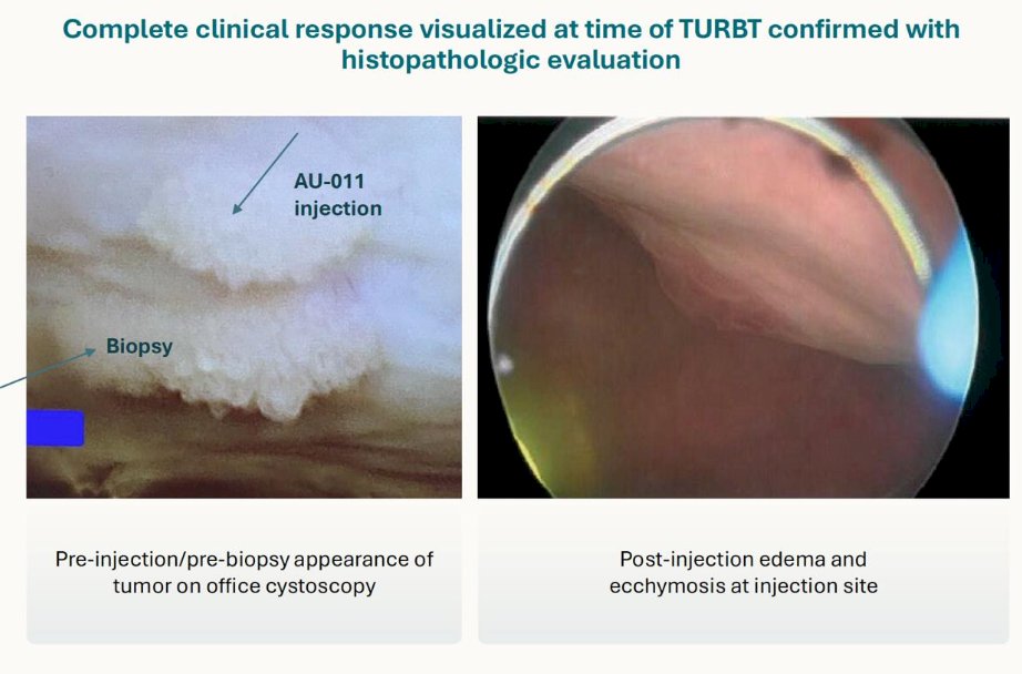 The initial results show impressive tumor regression and immunology:&nbsp;