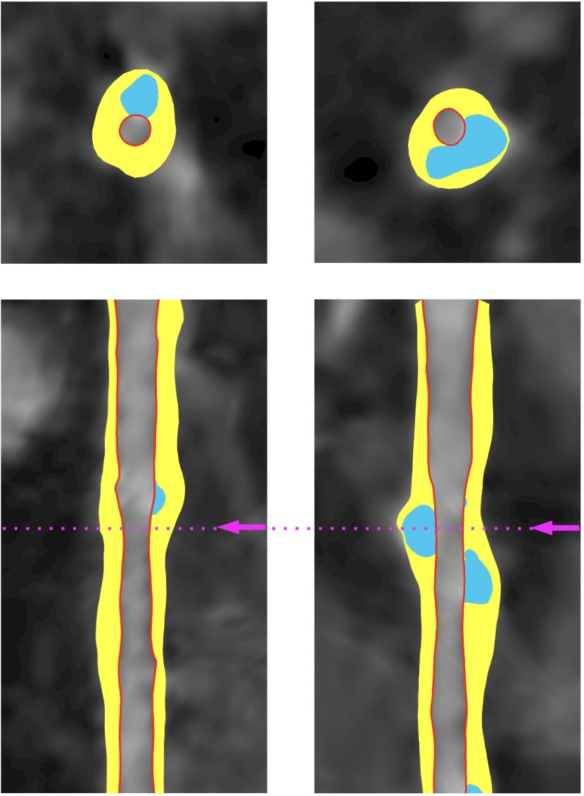 The primary endpoint was the change in total coronary artery plaque volume, measured by prospective coronary CT angiography completed at baseline and 12 months after treatment initiation. Other outcome measures included change in non-calcified plaque volume, calcified plaque volume, and low-attenuation plaque volume, as well as the incidence of major adverse cardiovascular events (stroke, myocardial infarction, coronary stent). The following figure highlights plaque assessment: