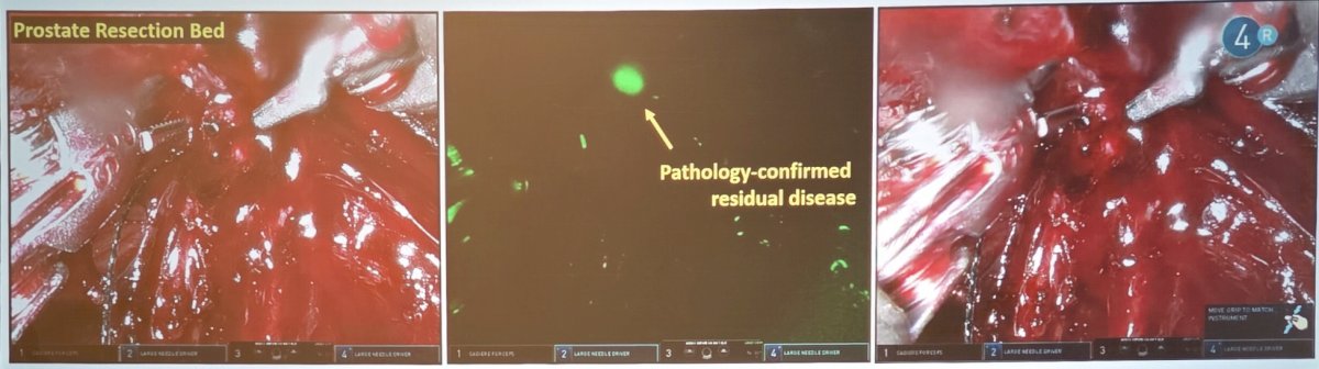 At UCSF, Dr. Carroll and colleagues undertook a phase I study using IS-002, with the primary objective of assessing safety and patient tolerance of IV-administered IS-002 on subjects undergoing robotic prostatectomy. The secondary objective was to evaluate the pharmacokinetics of IS-002, and an exploratory objective was to assess IS-002 efficacy in detecting prostate cancer. The population of patients for this study was high-risk men (CAPRA 6+). IS-002 enabled real-time visualization of residual prostate cancer not visible under standard white-light endoscopy, and biopsied fluorescent tissue confirmed adenocarcinoma:1