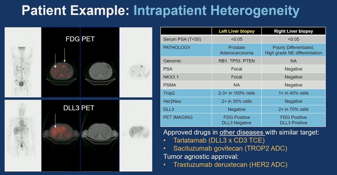 Initially, the importance of lineage plasticity was emphasized. Prostate cancer is not static, and under therapeutic pressure, tumors can evolve into distinct phenotypes within the same patient. The example presented illustrated intrapatient heterogeneity, with one liver lesion consistent with adenocarcinoma and another demonstrating high-grade neuroendocrine differentiation, accompanied by divergent biomarker expression and imaging characteristics. This biologic divergence has direct therapeutic implications, as different lesions may express targets such as DLL3, TROP2, or HER2, opening the door to agents approved in other malignancies. Recognizing lineage plasticity is critical, as it underscores the need for repeat biopsy, molecular reassessment, and adaptive treatment strategies rather than assuming uniform disease biology throughout the course of CRPC.