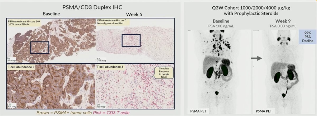 The second patient was a 63-year-old male with lymph node and bone lesions, who had received 5 prior lines of therapy, including enzalutamide, docetaxel, TAS AR antagonist, and radioligand therapy (225Ac-pelgifatamab). The patient had a complete response of target lesions and a non-complete response/non-progressive disease for non-target bone lesions. He also had a PSA99 response at cycle 2 day 1 (week 4). Importantly, he had an excellent quality of life, with a significant reduction in pain. The patient withdrew from the study on cycle 5, while in remission and deriving significant benefit: