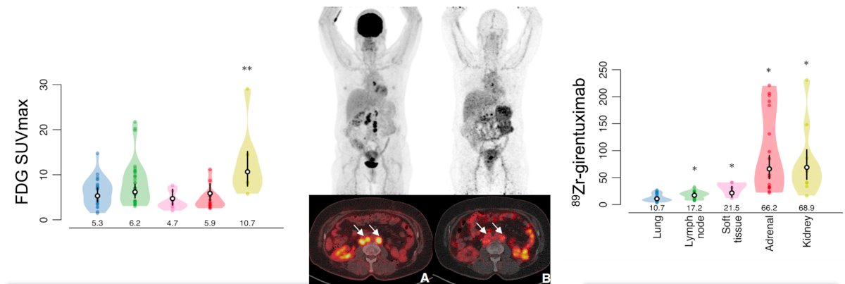 Dr. Hofman notes that for the prognostic value of FDG PET versus 89Zr-DFO-girentuximab, FDG PET may improve the decision for watchful waiting in good prognosis metastatic clear cell RCC, whereas the role of 89Zr-DFO-girentuximab is in confirming a clear cell RCC lesion in a minimally invasive fashion, considering the very high SUVmax findings seen in positive scans: