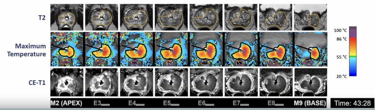 The median fraction of the gland reaching ablative temperatures on intra-procedural MRI thermometry was 78% (IQR 71-85), with 68% of cases comprising whole gland ablation and 32% sub-total ablation: