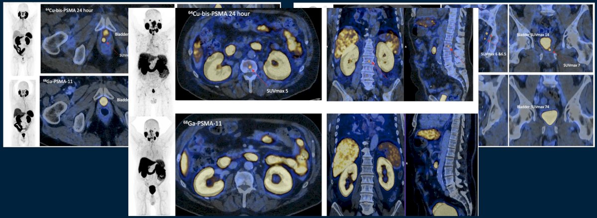 Planned management changed between scans in 22/50 (44%), with 12/22 (55%) changing from surveillance to radiotherapy. Cohen’s Kappa was 0.94 for 64Cu-SAR-bis-PSMA versus 0.75 for 68Ga PSMA-11 PET/CT based on blinded expert triple read using SPARC criteria. The diagnostic accuracy is as follows: