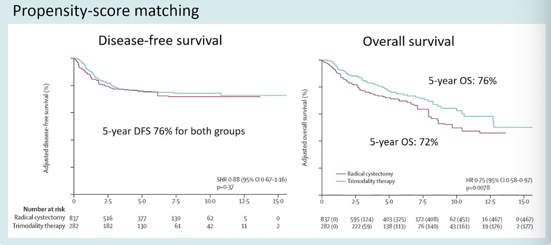 Using a 3:1 propensity score matching strategy and inverse probability of treatment weighting, the investigators compared oncologic outcomes between radical cystectomy and trimodality therapy. In the matched analysis, disease-free survival was nearly identical between groups, with a 5-year DFS of 76% for both strategies. Overall survival, however, favored trimodality therapy, with a 5-year OS of 76% compared with 72% for radical cystectomy (HR 0.75, 95% CI 0.58–0.97; p=0.0078).1