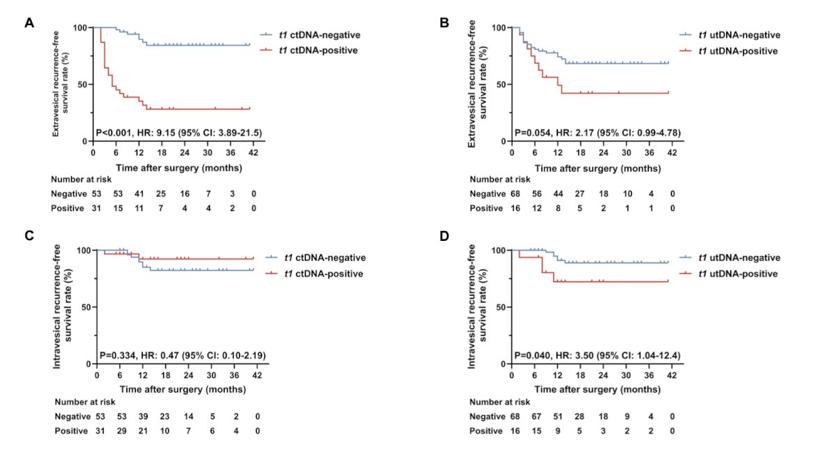 At a median 19.0-month follow-up (range 5.0–41.0), 46.4% (39/84) of patients developed recurrence (29 extravesical, 10 intravesical). Liquid biopsy detected molecular residual disease at a median lead time of 95.0 days (IQR 53.0–214.0) before clinical recurrence. T1 ctDNA positivity predicted an 8.7-fold higher extravesical recurrence risk (HR 8.7, 95% CI 3.7–20.6; p < 0.001):&nbsp;