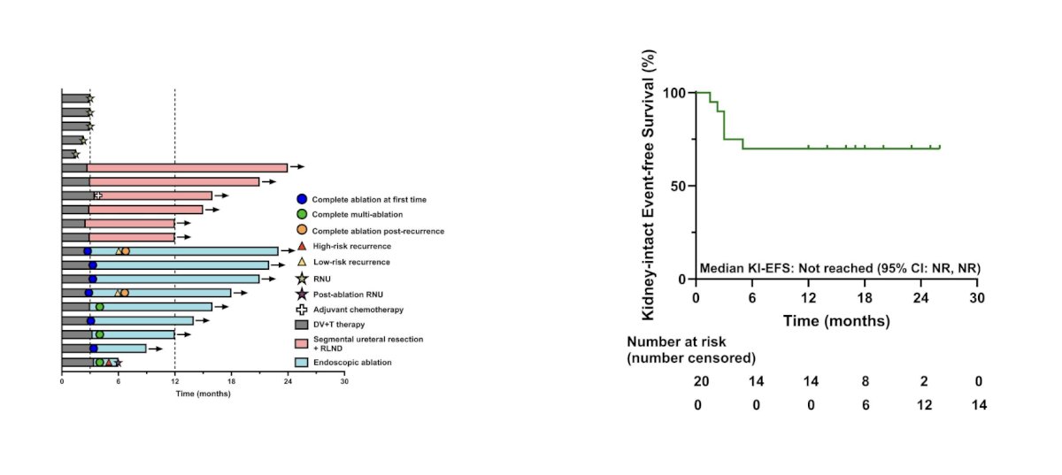 Kidney-sparing procedures included ureteral segmental resection (n = 6) and endoscopic ablation (n = 9), with 5 patients undergoing radical nephroureterectomy. One recurrence after ablation required salvage radical nephroureterectomy at 6 months. The 1-year kidney intact event-free survival was 70% (14/20), and the clinical complete response rate was 25.0% (5/20) after completion of induction therapy (3-month assessment), which increased to 75.0% (15/20) after the subsequent kidney-sparing surgical procedures (4-month assessment):