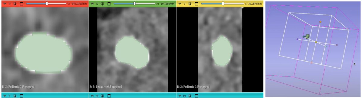 The authors conducted a retrospective cohort study of 72 (39 male and 33 female) pediatric patients between 1 and 17 years of age, who underwent ultrasound guided extracorporeal shockwave lithotripsy (ESWL) (first-line treatment) or semirigid/flexible ureteroscopy (URS) (second-line treatment) for single urinary tract stones between January 2023 and June 2025. Patients were grouped into three volumetric categories: Group I (≤100 mm³), Group II (101–200 mm³), and Group III (201–370 mm³), as measured using the 3D Slicer software. All stones measured less than 20 mm by maximum linear measurement, and treatment success was evaluated using stone-free rates determined by ultrasound, three months following intervention.
