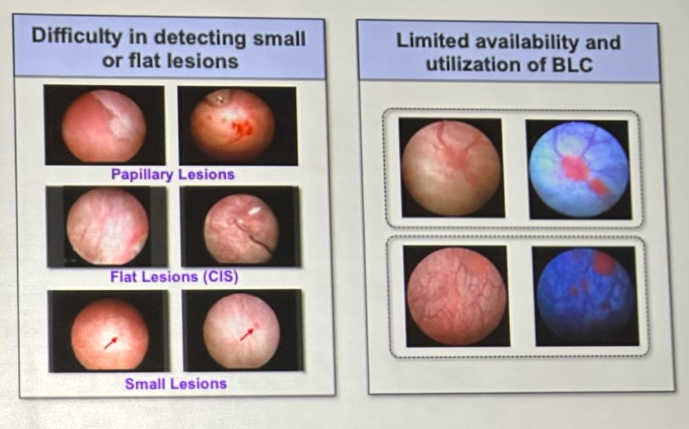 One of the major clinical applications discussed was bladder tumor detection during cystoscopy. Dr. Liao noted that conventional white-light cystoscopy remains highly operator dependent and may occasionally miss small papillary tumors or flat lesions such as carcinoma in situ. To address these limitations, several groups have developed CNN-based models trained using pathologically confirmed cystoscopic images and videos. Early studies demonstrated encouraging performance, with some systems achieving sensitivities and specificities approaching expert-level interpretation.&nbsp;