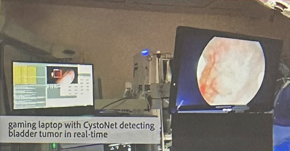 Importantly, the field is now beginning to move beyond retrospective image analysis toward real-time intraoperative implementation. Dr. Liao presented work from his group involving a computer vision platform integrated directly into a cystoscopy tower using a portable gaming laptop capable of performing live tumor detection with clinically acceptable latency. He also reviewed similar efforts from international groups developing real-time AI-assisted cystoscopy systems, further supporting the feasibility of clinical deployment during active procedures.