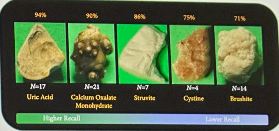 Another major focus of the lecture involved computer vision applications for kidney stone analysis. Dr. Liao explained that laser lithotripsy frequently fragments stones extensively, which may limit the ability to obtain adequate specimens for formal chemical analysis. However, intraoperative knowledge of stone composition may help optimize laser settings and guide postoperative metabolic management. Early work from the University of Michigan demonstrated that AI models trained on digital stone photographs could classify major stone types with promising accuracy. Subsequent studies expanded this concept using ureteroscopic video frames rather than still images while also incorporating automated stone segmentation.