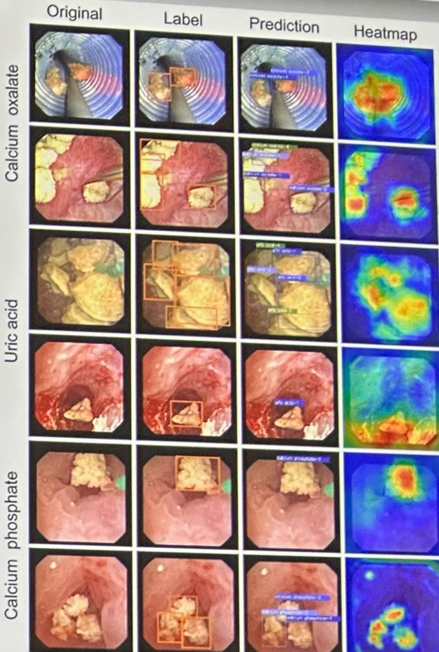 Dr. Liao also reviewed more advanced multi-task AI systems capable of simultaneously performing stone detection, composition classification, stone sizing, and residual fragment quantification in real time. Some models demonstrated strong performance across multiple stone compositions, including calcium oxalate and calcium phosphate stones. Particularly notable was the ability of these systems to quantify residual fragments smaller than 1–2 mm and correlate those findings with future reoperation risk, representing one of the first examples of computer vision data being directly linked to clinically meaningful postoperative outcomes in endourology.
