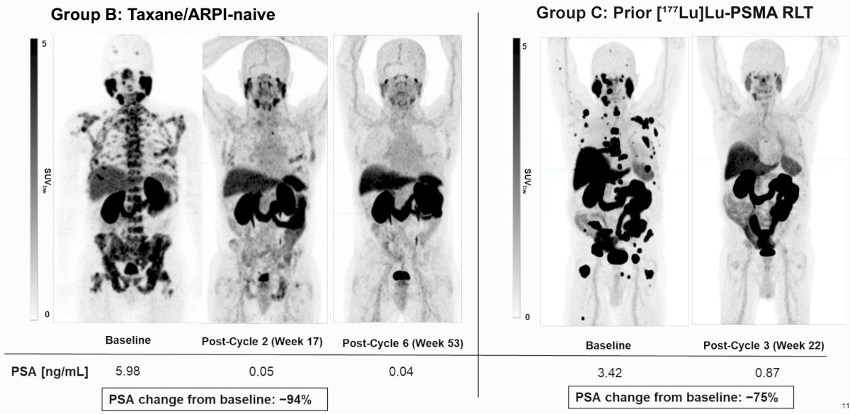The following figure shows PSMA PET/CT and biochemical responses following 225Ac-PSMA-617 treatment in Group B and Group C patients:
