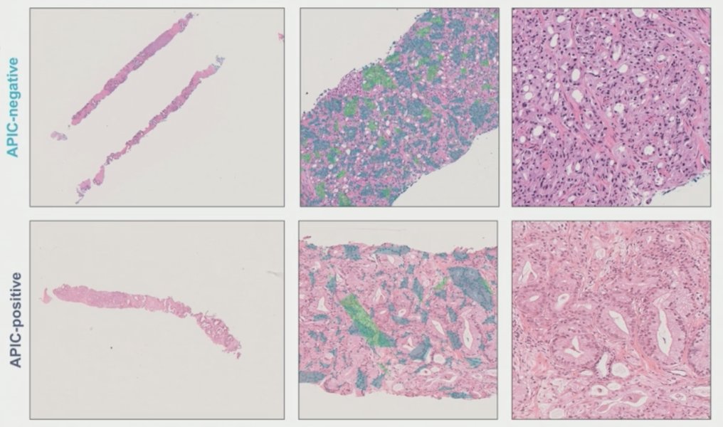 Participants with APIC-negative disease showed higher immune infiltrates on H&E: