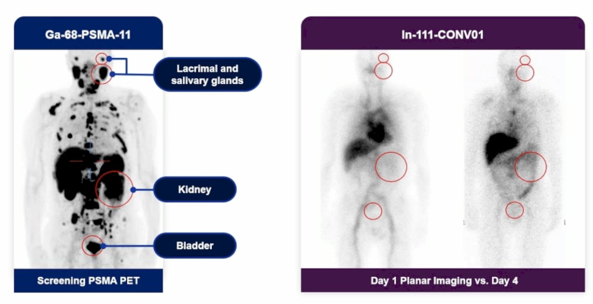 Of note, Dr. Morris emphasized that CONV01-α is not visualized in the salivary glands or the urinary system: