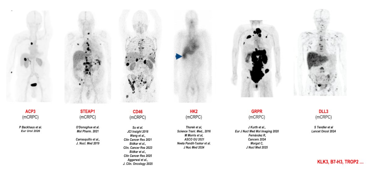 Dr. Calais also discussed several emerging therapeutic targets in mCRPC beyond PSMA. These include STEAP1, CD46, hexokinase-2 (HK2), gastrin-releasing peptide receptor (GRPR), DLL3, ACP3, KLK3, B7-H3, and TROP2. These targets may ultimately provide therapeutic opportunities for patients whose tumors exhibit heterogeneous PSMA expression or resistance to PSMA-directed treatment:&nbsp;