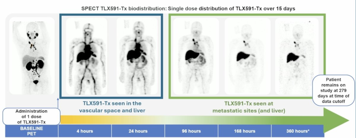 The first case presented by Dr. Barata was of a 64-year-old patient with metastatic disease in the lymph nodes treated with TLX591-Tx + abiraterone. He had a baseline PET and was subsequently treated with 1 dose of TLX591-Tx, which was seen in the vascular space and liver on SPECT at 4 hours and 24 hours, followed by TLX591-Tx seen at the metastatic sites and liver at 96 hours, 168 hours, and 360 hours. The patient remains on study at 279 days at the time of data cut-off:&nbsp;