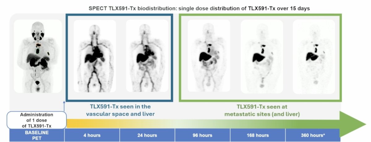 The second case was an 83-year-old patient with bone metastatic disease treated with TLX591-Tx and sequenced with docetaxel. Similarly, TLX591-Tx, which was seen in the vascular space and liver on SPECT at 4 hours and 24 hours, followed by TLX591-Tx seen at the metastatic sites and liver at 96 hours, 168 hours, and 360 hours:&nbsp;