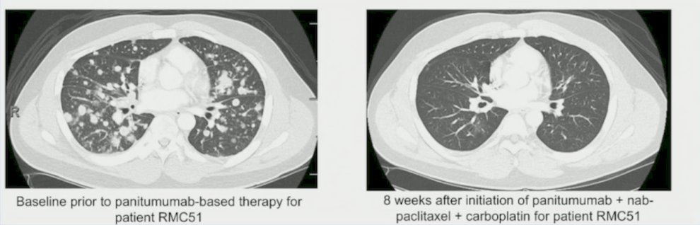 Dr. Msaouel provided the following example of effective panitumumab-based therapy in the fifth-line setting, showing before and after treatment lung CT scans: