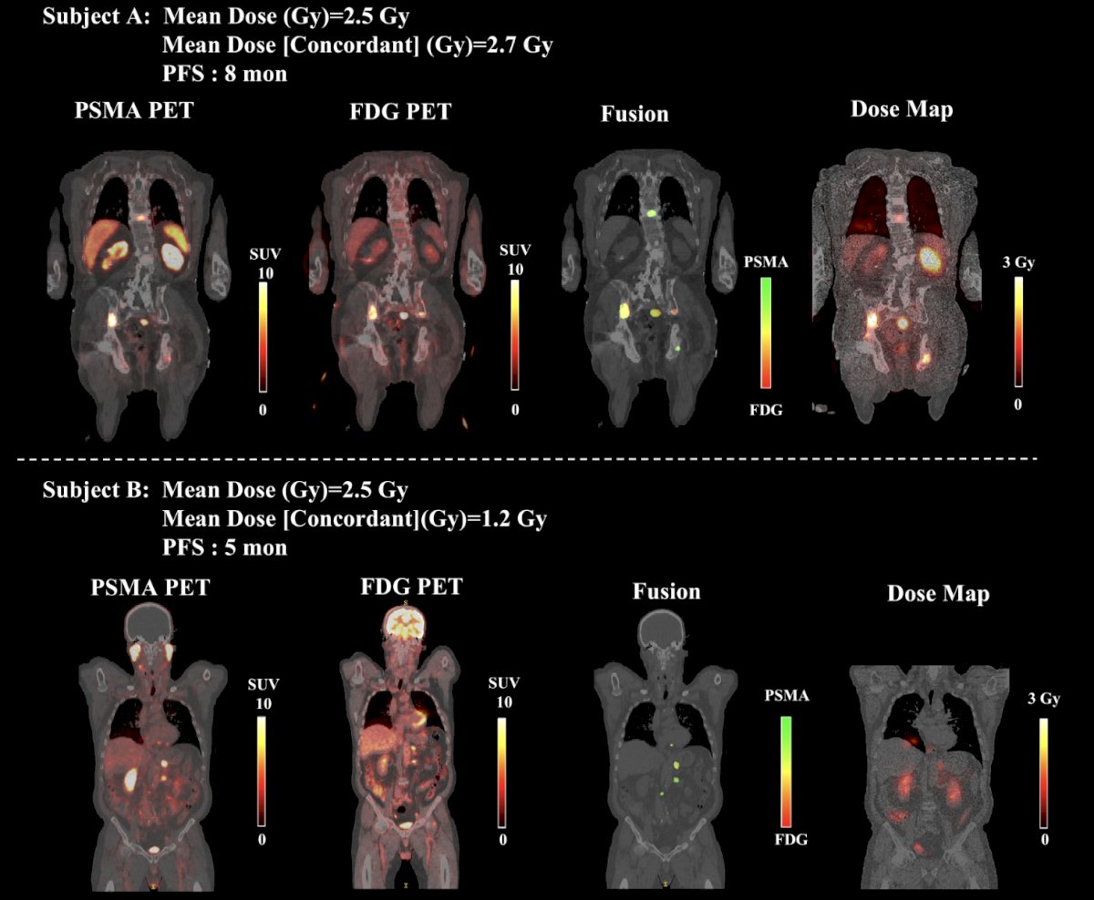 The following figure shows two representative patients with a low overall mean lesion absorbed dose. For each patient, the mean absorbed dose across all lesions and mean absorbed dose in PSMA+/FDG+ (concordant) lesions are displayed, together with the corresponding progression-free survival interval:&nbsp;