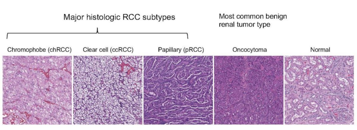 artificial intelligence classification for RCC-0.jpg