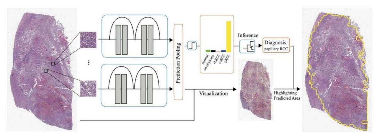 artificial intelligence classification for RCC-1.jpg