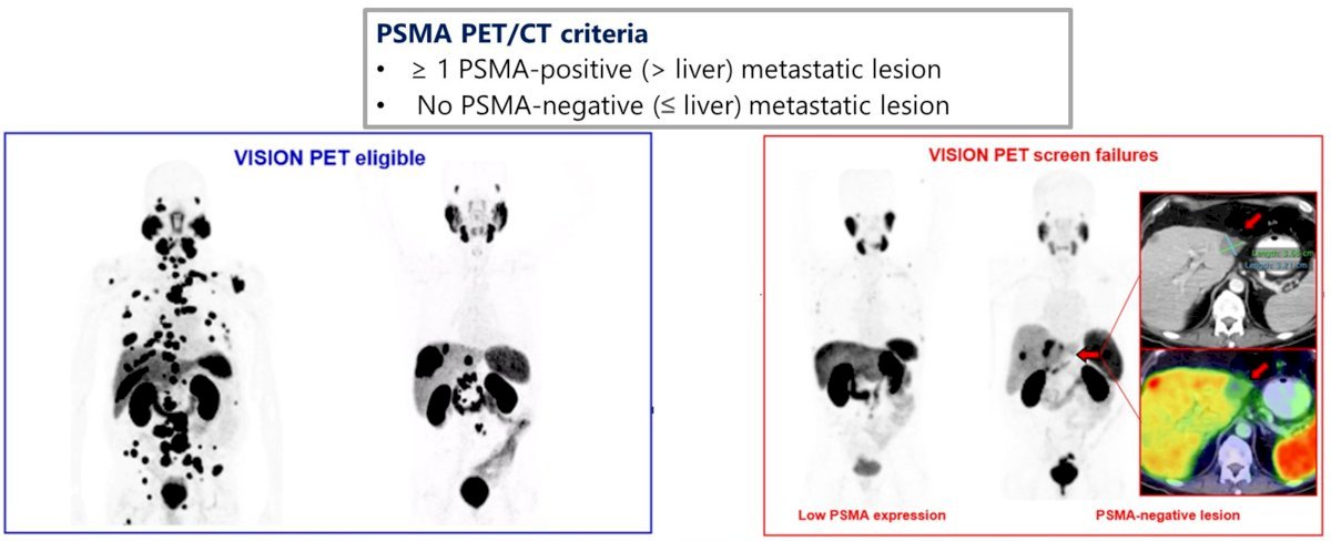 ASCO PSMA PET-CT-0.jpg