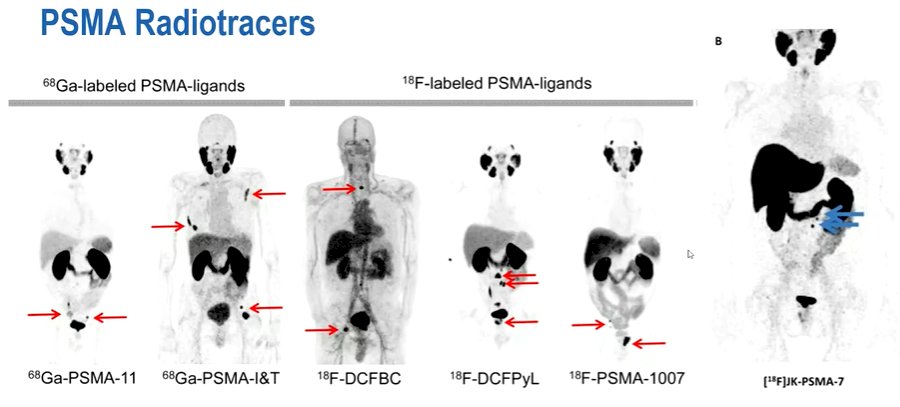 Prostate_Specific_Membrane_Antigen_PSMA_Image_1