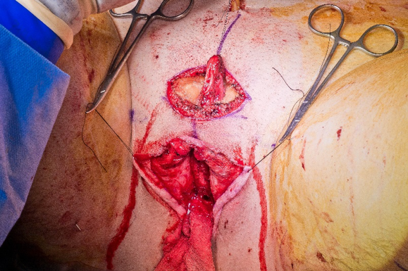 distal_urethra_and_clitoris.png
