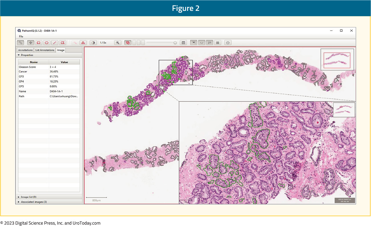 figure-2-AI-prostate-cancer2x.jpg