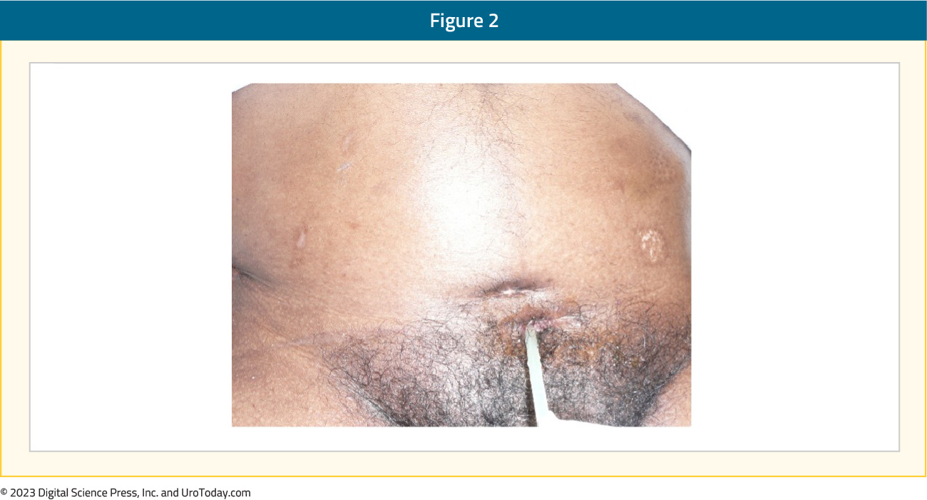 figure-2-suprapubic-catheter-overview2x.jpg