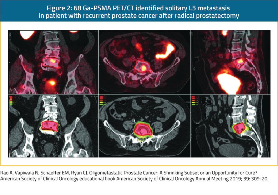 figure 2 68 GA PSMA PET CT
