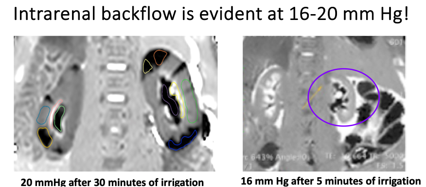 intrarenal_backflow.jpeg