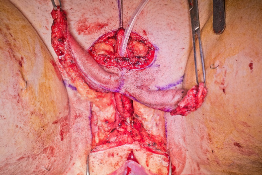 labia_majora_flaps.png