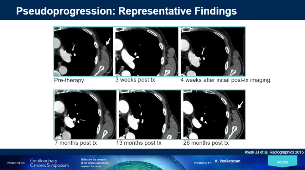 pseudoprogression representative findings