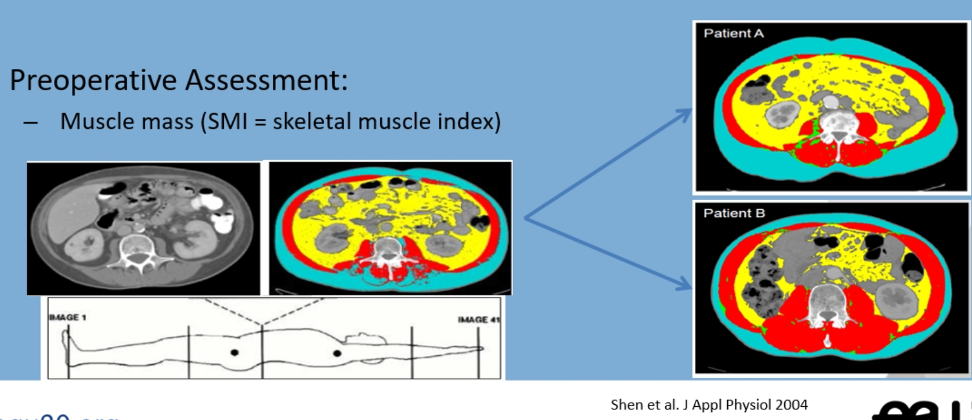 skeletal muscle index assessment